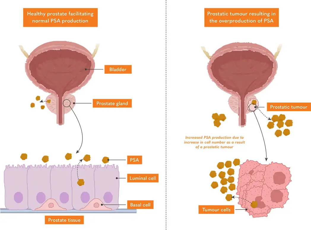 xPSA-production-in-tumours